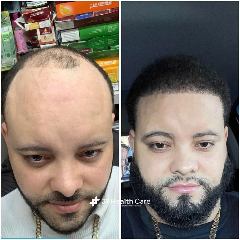 DHI (Direct Hair Implantation)